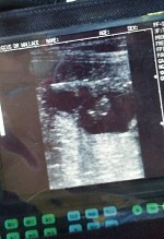 Kůzle na ultrazvuku.